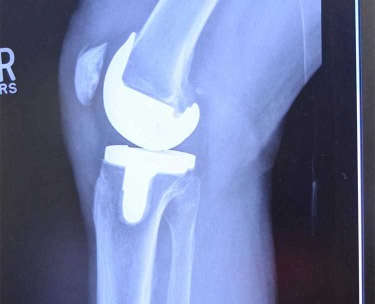 knee xray image